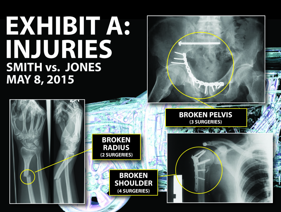 Trial exhibit of injury x-rays